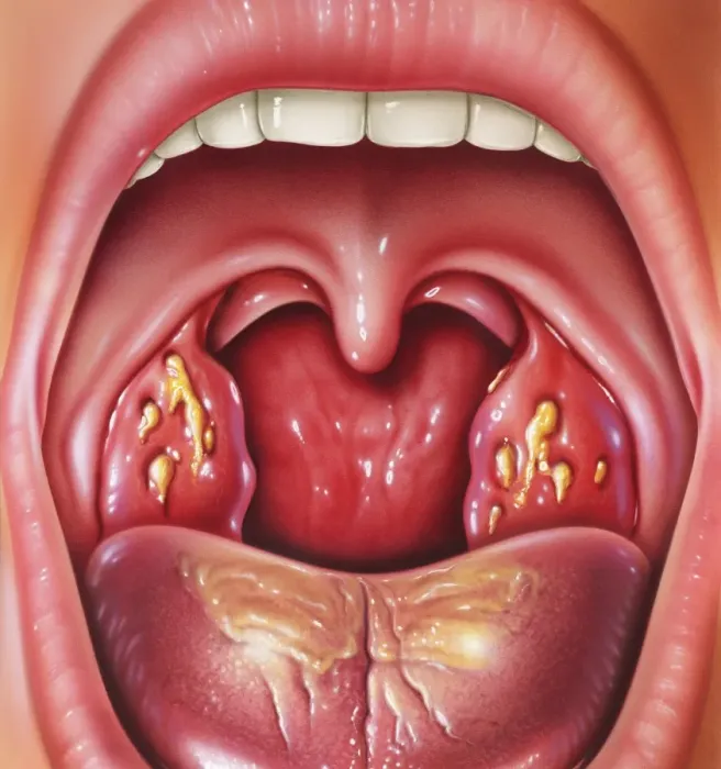Impression encadrée : Tonsillitis Impression encadrée : Tonsillitis