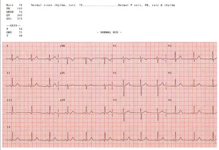 Impression encadrée : Électrocardiogramme normal