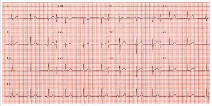 Impression encadrée : Électrocardiogramme normal.