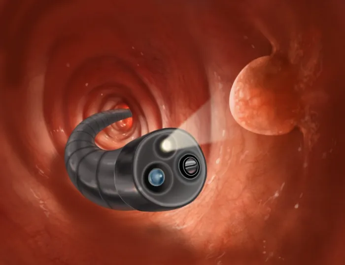 Impression encadrée : Colonoscopy avec Polypes.