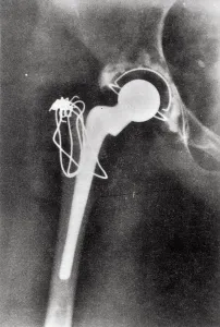 Photos Des Archives De L'IMechE Impressions: Remplacement de l'articulation hanche par rayonnement X