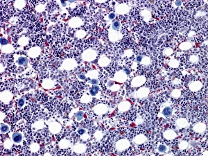 Impressions de Le marbre osseux sous microscopie lumineuse. Les grandes cellules bleues sont des megakaryocytes qui forment les plaquettes Images datées de 2010 mars: Marrow osseux, image à microscope d'ordre léger