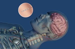 Deep Brain Stimulation Impressions: Brain pacemaker, artwork