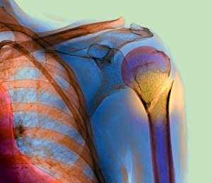 Os du bras cassé sur radiographie