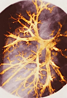 Images datées de 2005 juin: Bronchite, radiographie