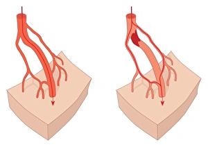Circulatory System Artwork Impressions: Collateral circulation, artwork