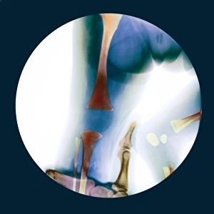 Impressions de Corréction de la luxation du genou : radiographie colorée d'un genoux déplacé et torsadé dans une petite fille qui est manipulée pour revenir à sa place. La main du médecin se trouve au bas Images datées de 2007 février: Dislocament corrigé du genou, radiographie