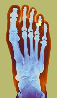 Impressions de Au pied d'une femme de 49 ans, radiographie en couleur du pied avec un tibia déplacé ; le joint déplacé est présent dans la couche jaune Images datées de 2008 janvier: Auclage du mâtillon, radiographie