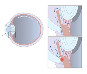 Glaucoma Treatment Impressions: Glaucoma, artwork