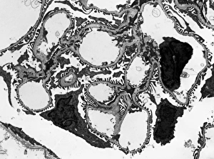Impressions de Un glomérulaire. Image de microscopie électronique de transmission (TEM) d'une section à travers un néphron dans une rein humain, montrant un groupe de capillaires au sein du corpuscle rénalien Images datées de 2013 février: Globuleur de filtration, TEM