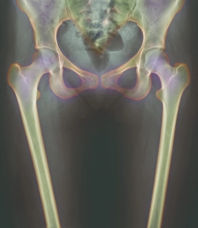 Images datées de 2002: Os du bassin et radiographie