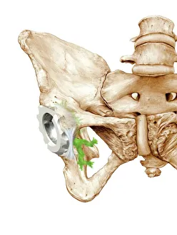 Impressions de Remplacement d'hippe. L'image d'un artère de la cavité du bassin avec un empattement articulaire prosthetique dans le bas-fond pelvien Images datées de 2011 juin: Remplacement d'hippe, art
