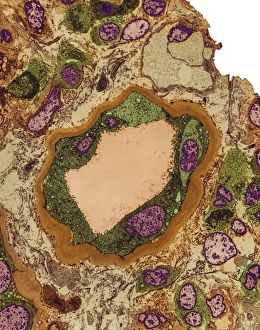 Coloured TEM Images Impressions: Hydronephrosis