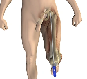 Osteoarthritis Treatment Options Impressions: Knee replacement alignment, artwork