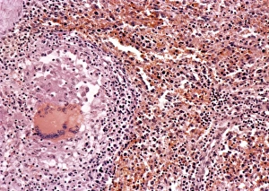 Mycobacterium Tuberculosis Bacteria Impressions: Miliary tuberculosis, light micrograph