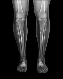 Rayon X Impressions: Jambes normales, radiographies
