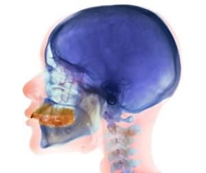 Impressions de Overbite. Radiograph X coloré de la tête d'une femme âgée de 32 ans montrant un surbitte du palais inférieur (jaune) et ses dentes Images datées de 2006 novembre: Oversieur de mordant, radiographie