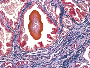 Impressions de Le prostate. Microscope à lumière de vision directe d'une tranche traversant une prostate montrant un concreté (rouge) de matériau sécrétory dans l'alvéole prostatique (espace aéré) Images datées de 2010 septembre: Le prostate, microscope à lumière faible
