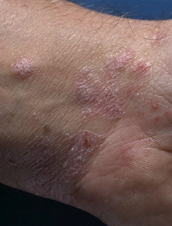 Images datées de 2003 juin: Psoriasis