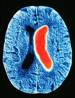 Computed Tomography Scans Impressions: Stroke