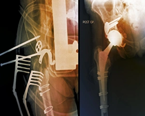 Hip Replacement Surgery Impressions: Total hip replacement, X-rays
