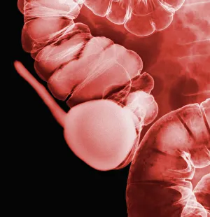 Images datées de 2012 avril: Radiograph de l'appendice