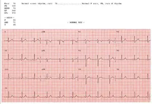 Électrocardiogramme normal