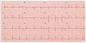 Impression encadrée : Électrocardiogramme normal.