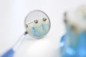 Dental Model Impressions: Detail of a model of teeth with braces