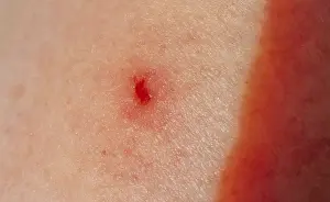 Freshwater Fish Habitat Impressions: Tick bite