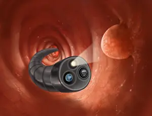 Images datées du 12 septembre 2012: Colonoscopy avec Polypes.