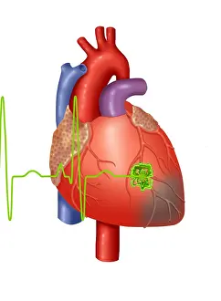 Medical Anatomy Drawing Impressions: Heart Attack