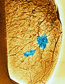 Medical Imaging Techniques Impressions: Mammogram