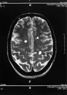 Medical Imaging Techniques Impressions: Multiple sclerosis