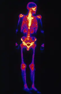 Medical Imaging Techniques Impressions: Normal Bone Scan