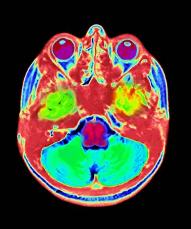 Normal Brain Anatomy Impressions: Normal MRI