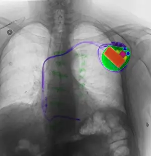 Human Anatomy Impressions: Pacemaker